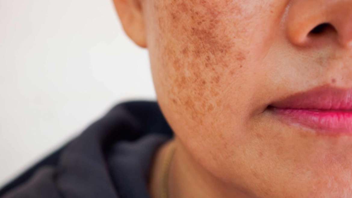 Laser Skincare For Pigmentation