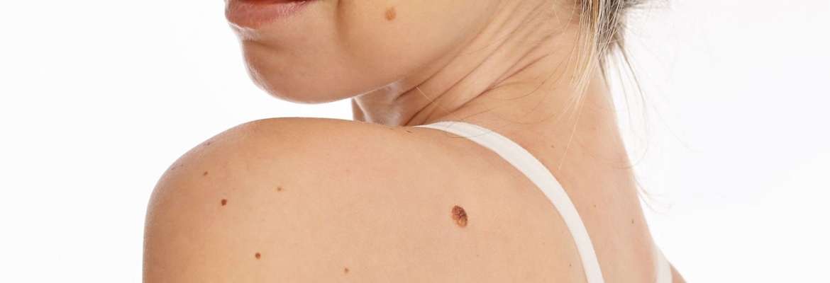 Laser treatment for Benign Moles