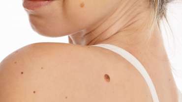 Laser treatment for Benign Moles