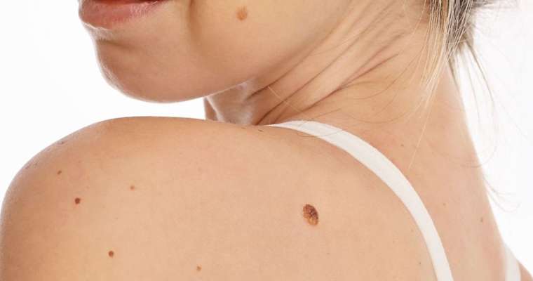 Laser treatment for Benign Moles