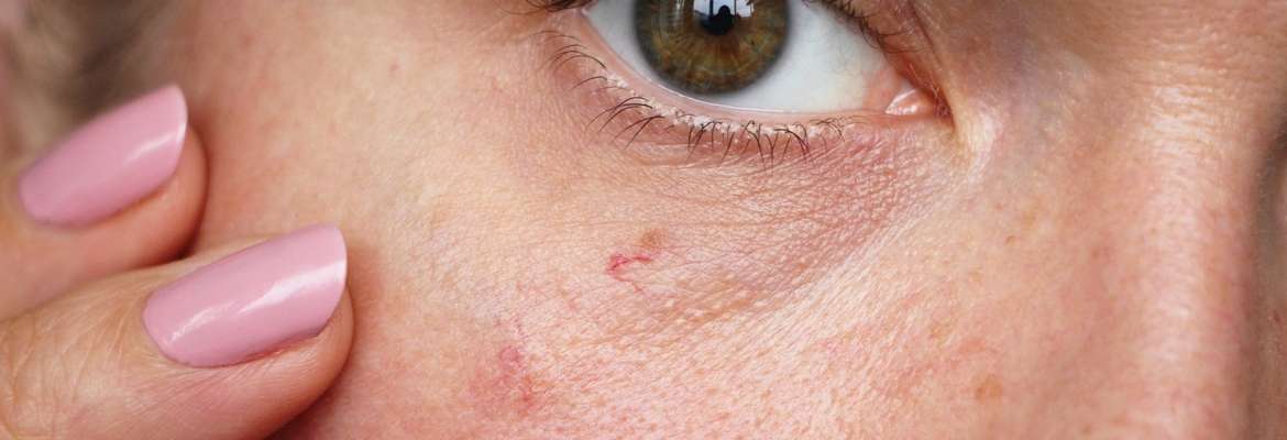 Laser Treatment of Superficial Blood Vessels