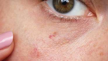 Laser Treatment of Superficial Blood Vessels